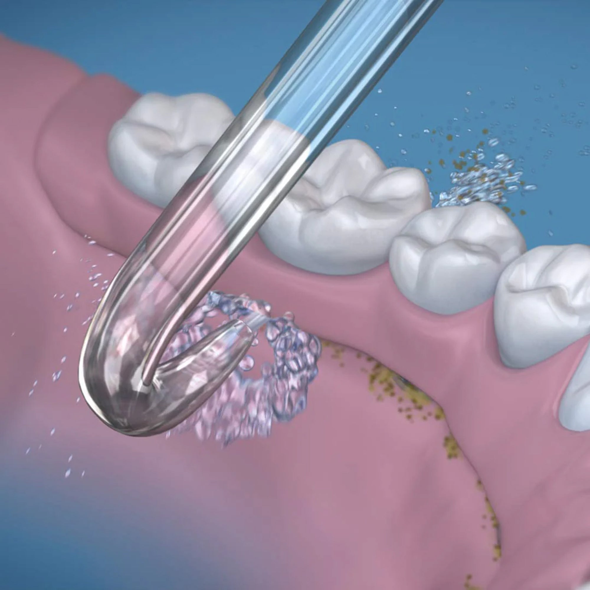 Implant Denture Water Flosser Tip