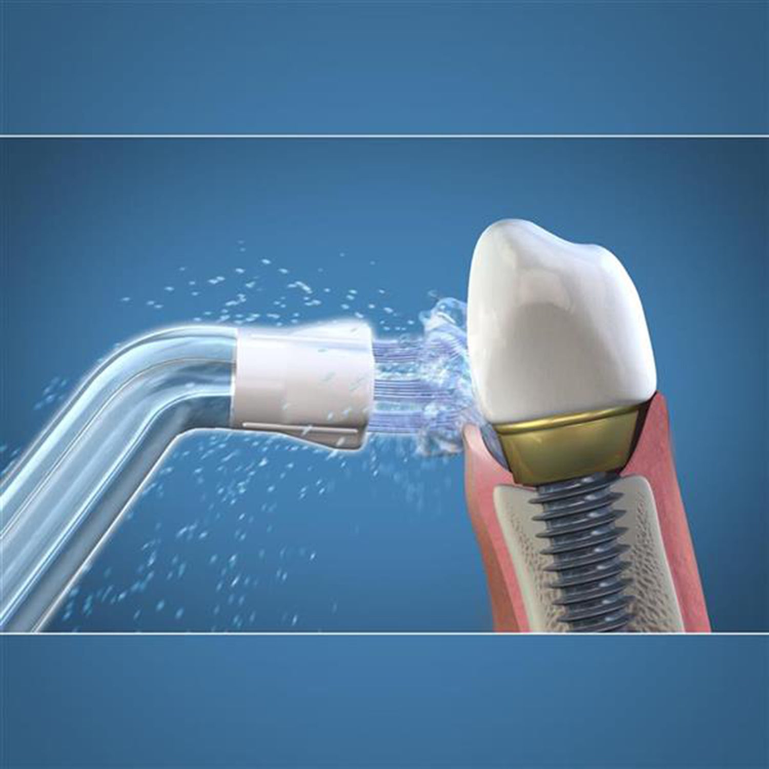 Plaque Seeker Water Flosser Tip