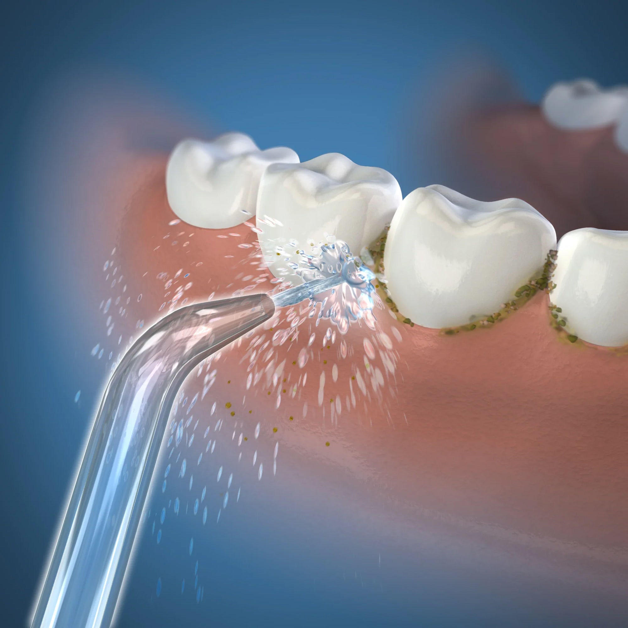 Precision (Classic) Handheld Cordless Water Flosser Tip