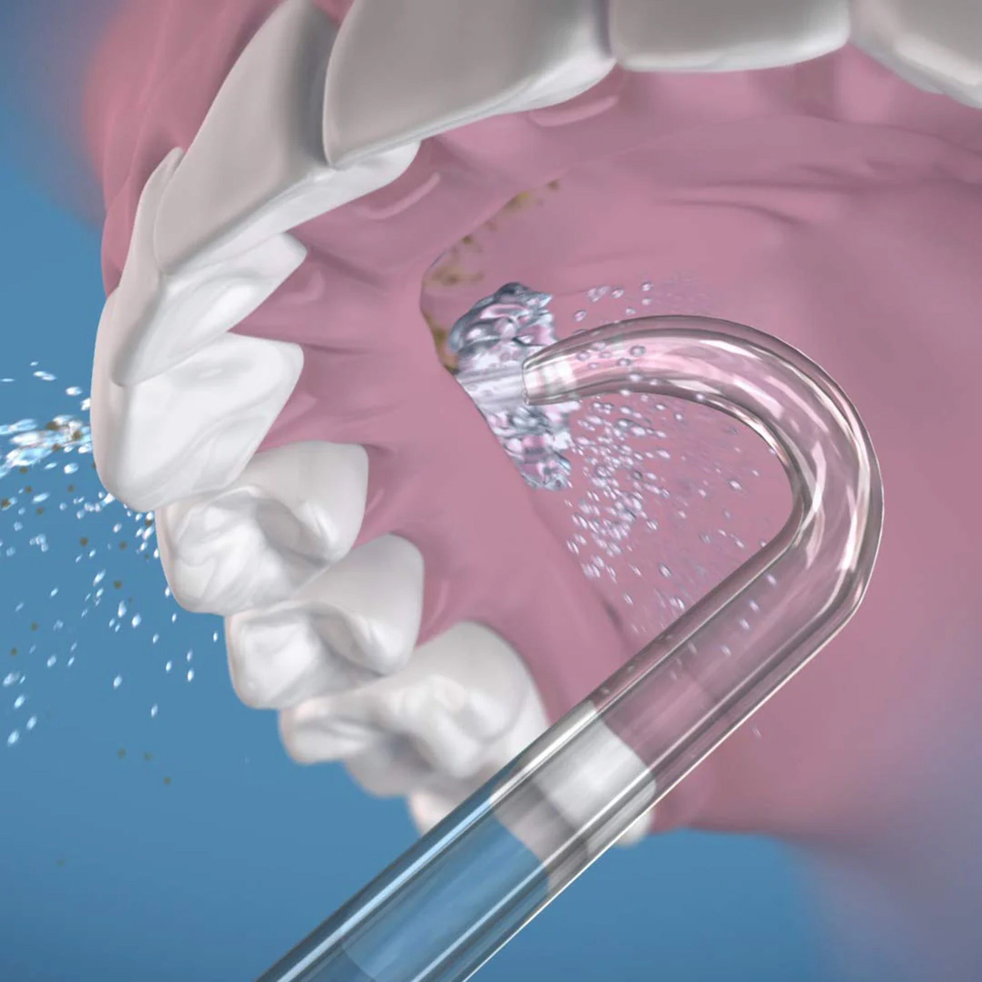 Implant Denture Water Flosser Tip